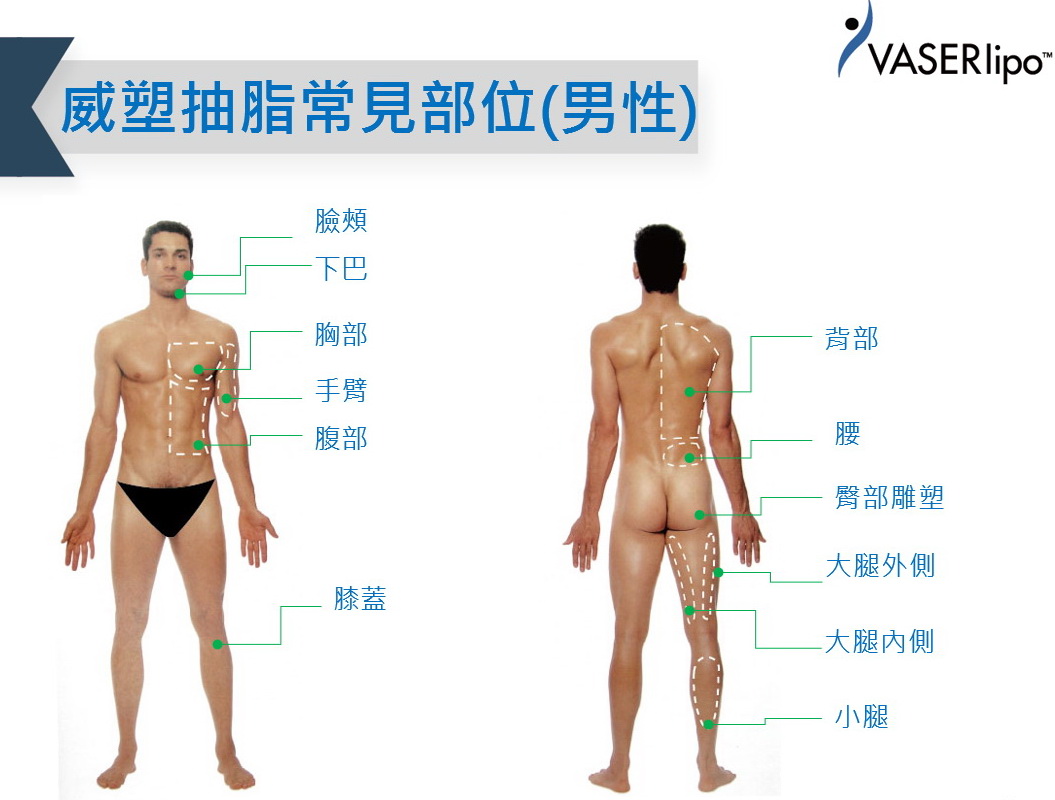 威塑抽脂，術後緊緻，適合回填雕塑