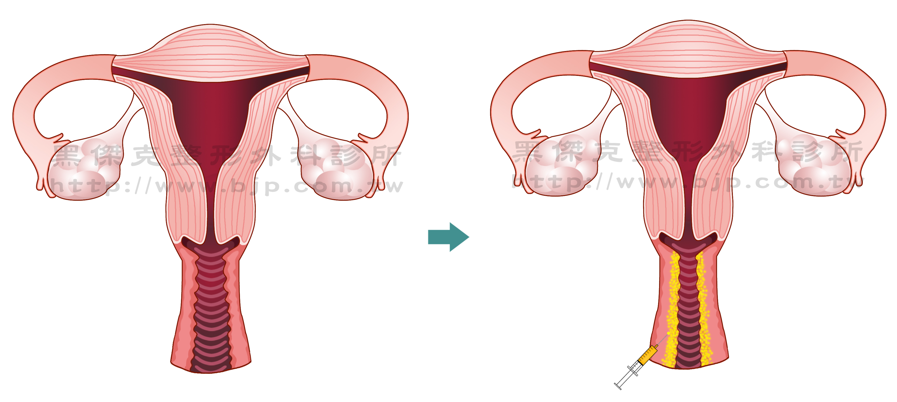 自體脂肪陰道緊實，原理是將自體脂肪平均注射到陰道內壁周圍，藉此讓陰道壁增厚，間接達到陰道緊實度增加的感覺，術後觸感自然柔軟