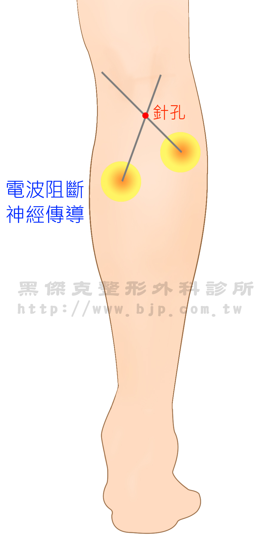 電波纖腿，是利用神經探測器進入小腿，刺激支配腓腸肌的神經，找出神經正確位置後，再以高頻雷射加熱至80度，產生微爆來破壞和阻斷神經