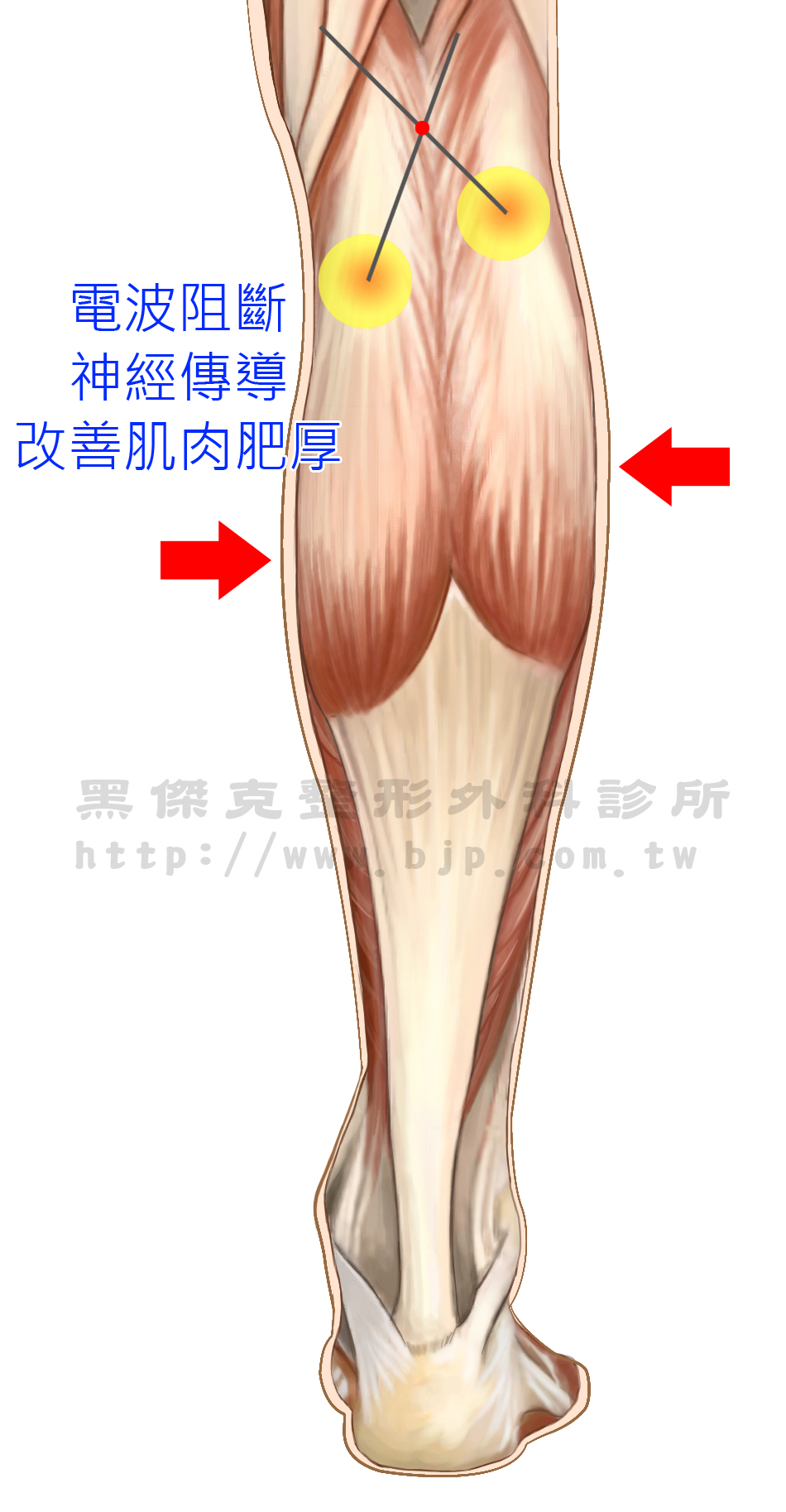 電波纖腿，被阻斷的神經所支配的肌肉，因為無法接受神經刺激而逐漸萎縮，達到瘦小腿的目的。