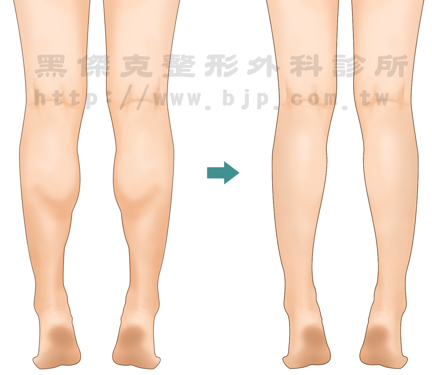 電波纖腿，小腿神經切斷術，經由膝窩處1.5-2公分的切口，將支配腓腸肌的神經切除一小段，被切斷的神經所支配的肌肉，因為無法接受神經刺激而逐漸萎縮，達到瘦小腿的目的。