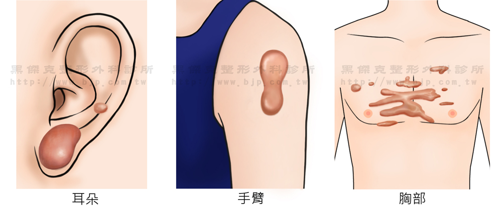 蟹足腫，疤痕會超過原傷口的界線且會橫向生長，不會自行消退，增生性疤痕與蟹足腫容易在前胸、肩膀、肩胛、下腹部、恥骨上方、耳垂等處產生