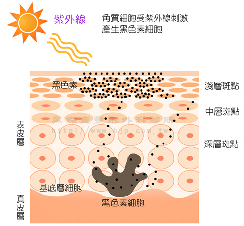 皮秒雷射除斑，美國皮秒雷射，以較短的時間傳遞雷射能量，搭配俗稱蜂巢透鏡或黃金蜂巢的微透鏡陣列，將能量聚焦，以達到較好的效果和較低的副作用，減少恢復期的困擾。