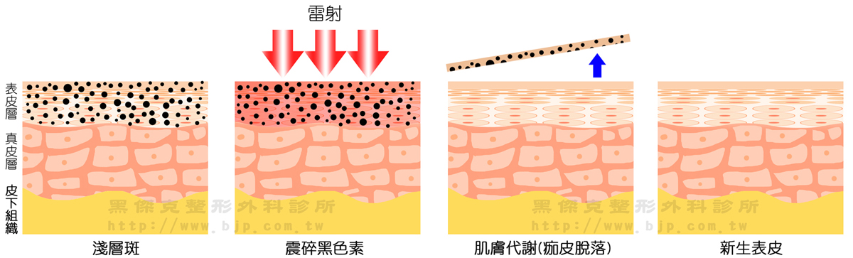 皮秒雷射除斑，波長較短的532nm對於雀斑、曬斑、老人斑有不錯的治療效果。