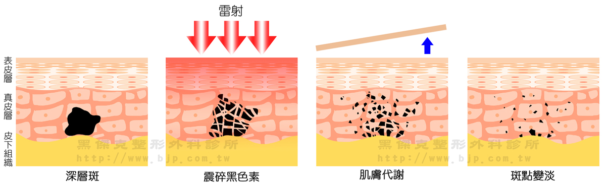 皮秒雷射除斑，波長較長的1064nm可以穿透到皮膚深層，用來治療深層色素，如顴骨斑、母斑及刺青。