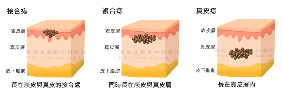 鉺雅鉻雷射除痣，後天性的痣則好發於青春期過後，日光刺激也是痣生成的來源。