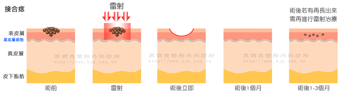 鉺雅鉻雷射除痣，接合痣長在表皮和真皮交界處，實際上在表皮內，通常小而扁平。