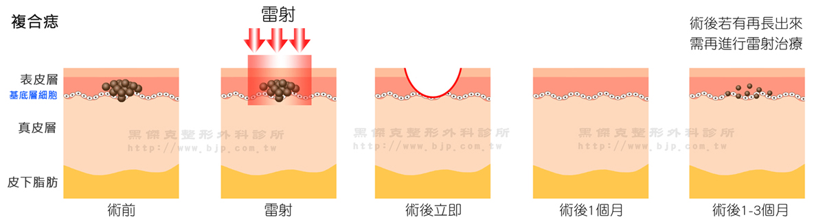 鉺雅鉻雷射除痣，複合痣長在表皮和真皮都有，有接合痣和真皮痣的成分，比接合痣較大和較突起些，但又比真皮痣扁平。