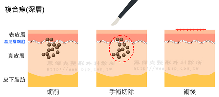 鉺雅鉻雷射除痣，複合痣(深層)，則需要透過手術處理，根據痣的黑色素範圍進行開刀移除、再將傷口縫合。