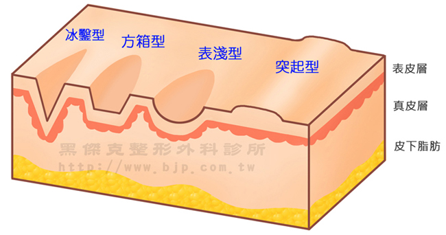 痘疤飛梭皮秒，以俗稱蜂巢透鏡或黃金蜂巢的微透鏡陣列，將皮秒雷射的能量聚焦在許多的小點，治療時不會產生如飛梭雷射的小傷口，藉由能量的刺激，造成組織的新生及重組，以達到改善膚質的目的。