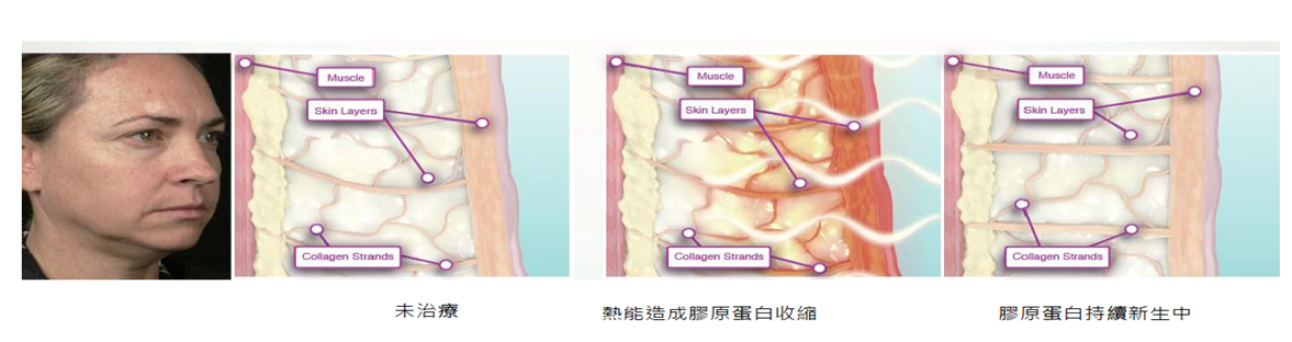 電波拉皮，深層真皮的加熱目標區，因此膠原蛋白的分子鍵結會出現變化，產生立即的組織收縮緊緻效果，並於隨後的數個月內，發揮膠原蛋白重組 的新生作用，可進行非侵入式皺紋及細紋之治療