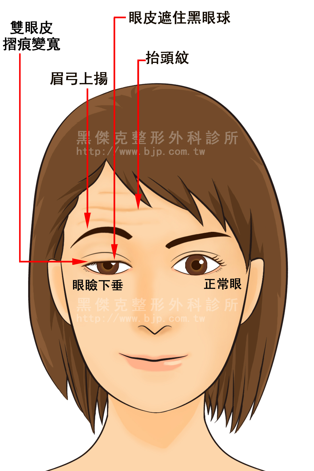 眼瞼下垂可分為先天性及後天性兩大類，先天性的眼瞼下垂是在出生的時候，提眼瞼肌的發育及功能就發生問題。後天性的眼瞼下垂則分為神經性、肌肉性、外傷性及機械性，首先，需排除由神經性及重症肌無力引起之眼瞼下垂，若是神經性及重症肌無力所引起，則需要進一步追查潛在的病因及藥物治療，其餘類型的眼瞼下垂則可以手術方式矯正。
