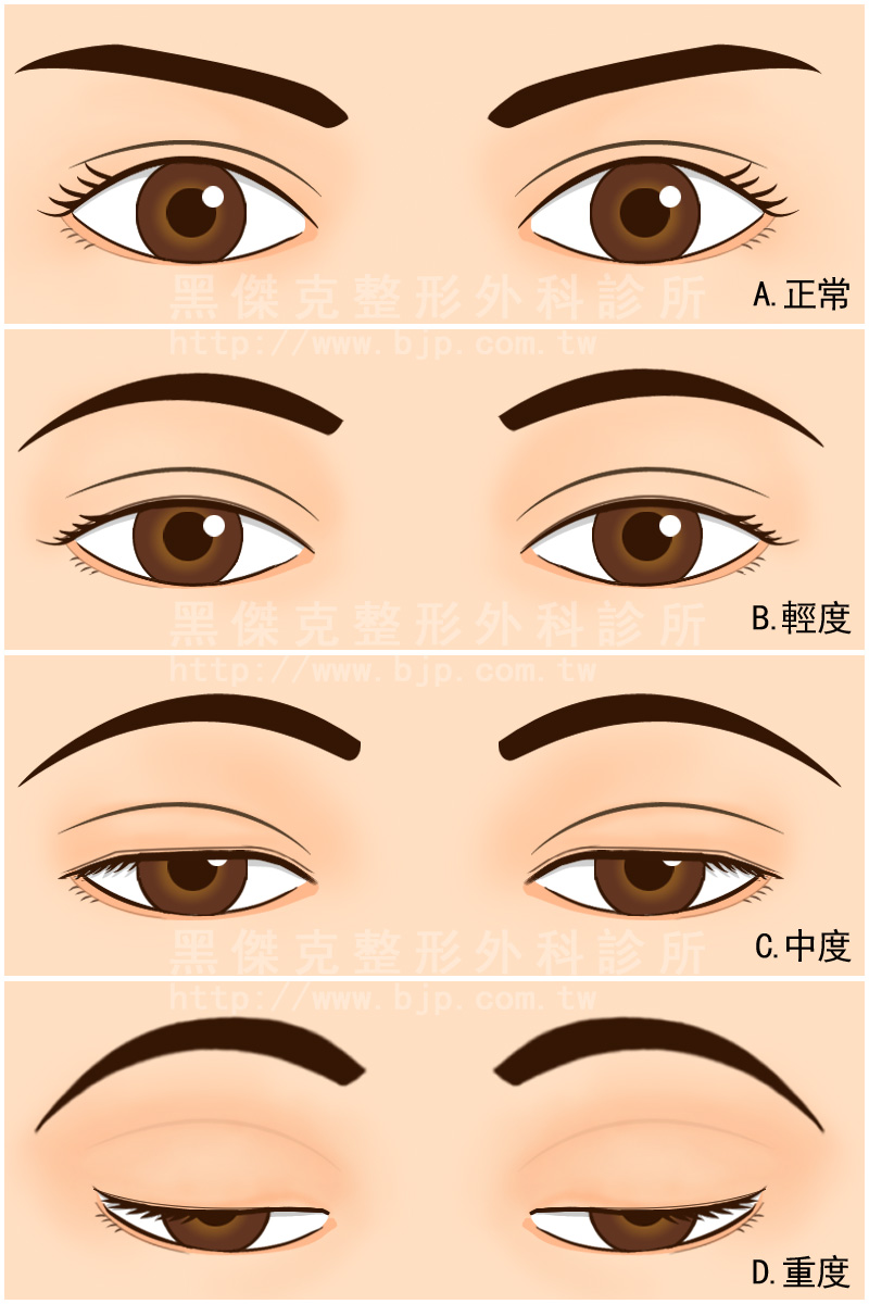 眼瞼下垂矯正,需透過手術改善時,提眼肌下垂手術的施作原則,術前與醫師做好充分的諮詢,及詳細理學檢查評估，針對眼瞼下垂的原因及嚴重程度來決定手術的方式